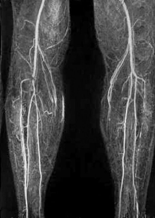 Asinsvadu x -ray