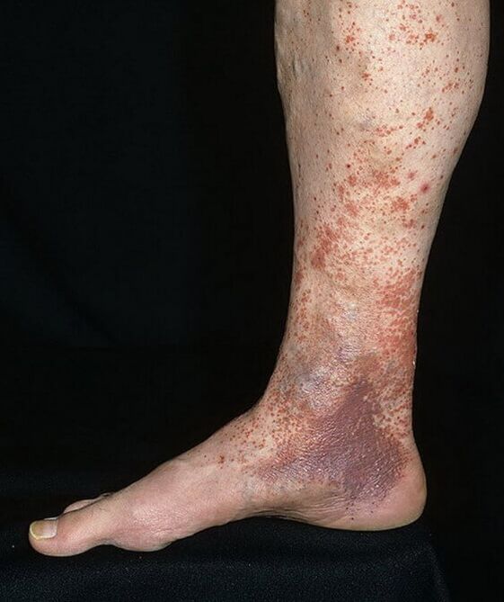 Varikozes dermatīts
