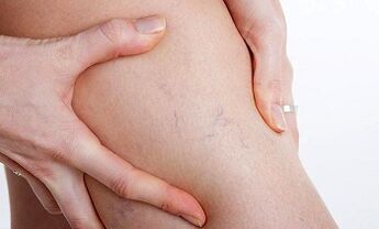 kāju vēnu varikozes attīstības iemesli