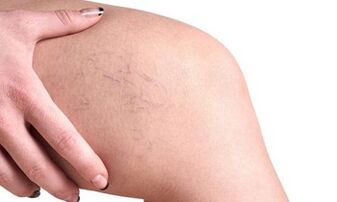 varikozu vēnu attīstības stadijas