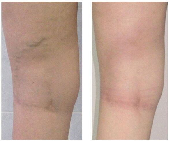 vēna kājā pirms un pēc varikozu vēnu ārstēšanas