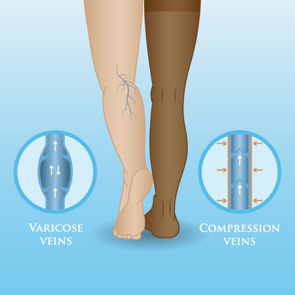 Kompresijas apģērba ietekme uz varikozām vēnām kājās