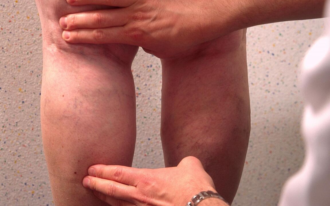 ārsts apskata kājas ar varikozām vēnām